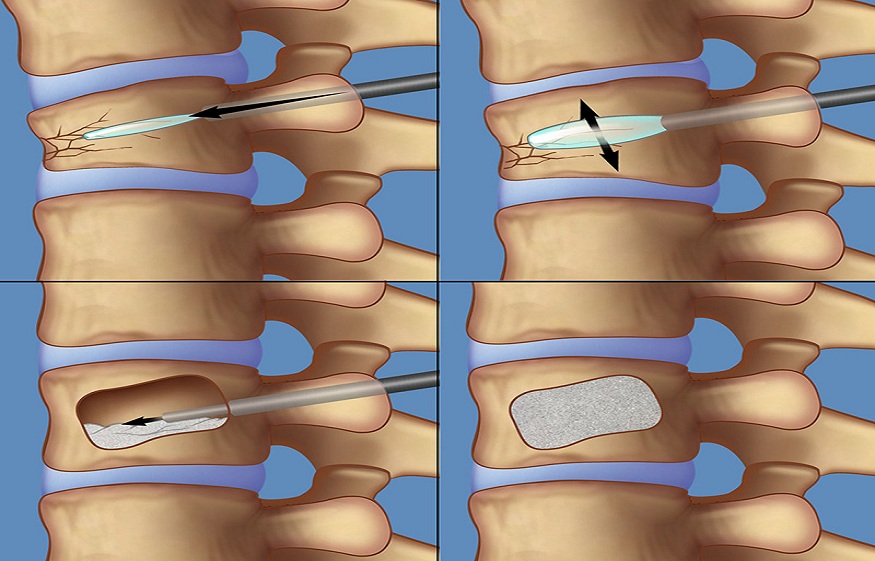 Spinal Fracture with Cement
